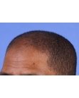 Before Hair Transplant&nbsp;Front